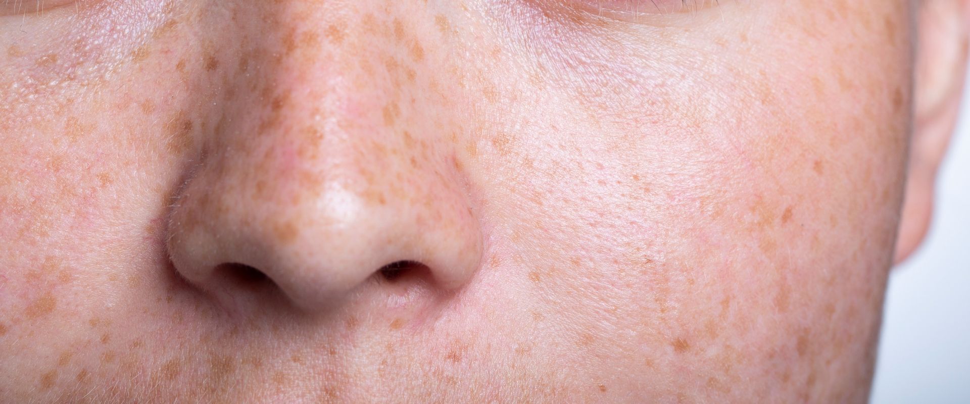 Macchie della pelle: il trattamento peeling bifasico