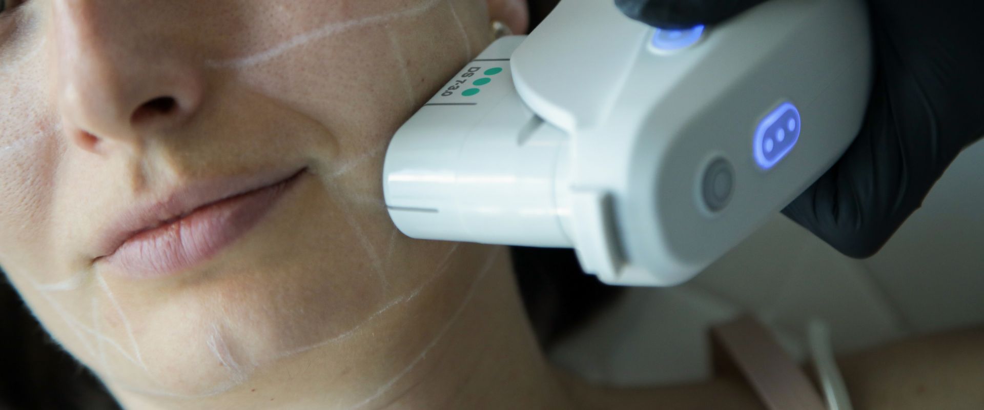 Combattere il rilassamento cutaneo con il lifting a ultrasuoni microfocalizzati