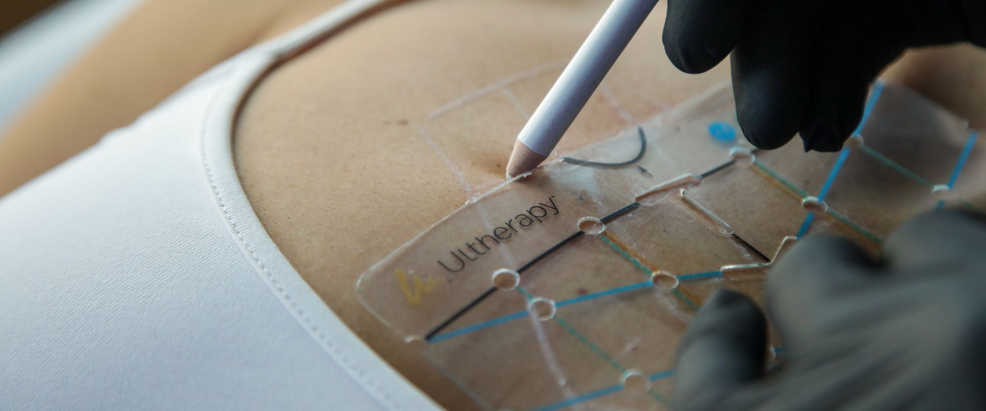 Rughe sul décolleté: trattarle con Ultherapy PRIME®